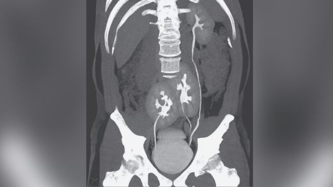 Shkon tek doktori për dhimbje kurrizi, zbulon se kishte 3 veshka